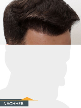 Herr P. O. - Beispiel Stirnhaargrenze nach der Behandlung
