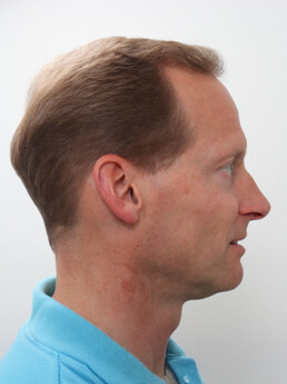 Christoph Stieg nach der Behandlung