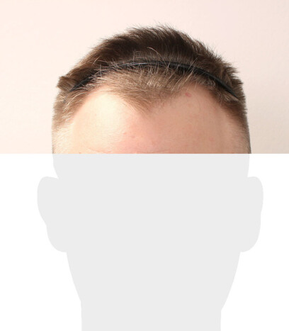 Herr S. Z. - Beispiel Geheimratscekcen vor der Behandlung