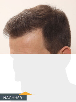 Herr K. W. - Beispiel Stirnhaargrenze nach der Behandlung