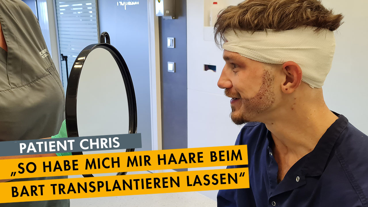 Bart Haartransplantation bei Chris - sein persönlicher Erfahrungsbericht | Moser Medical