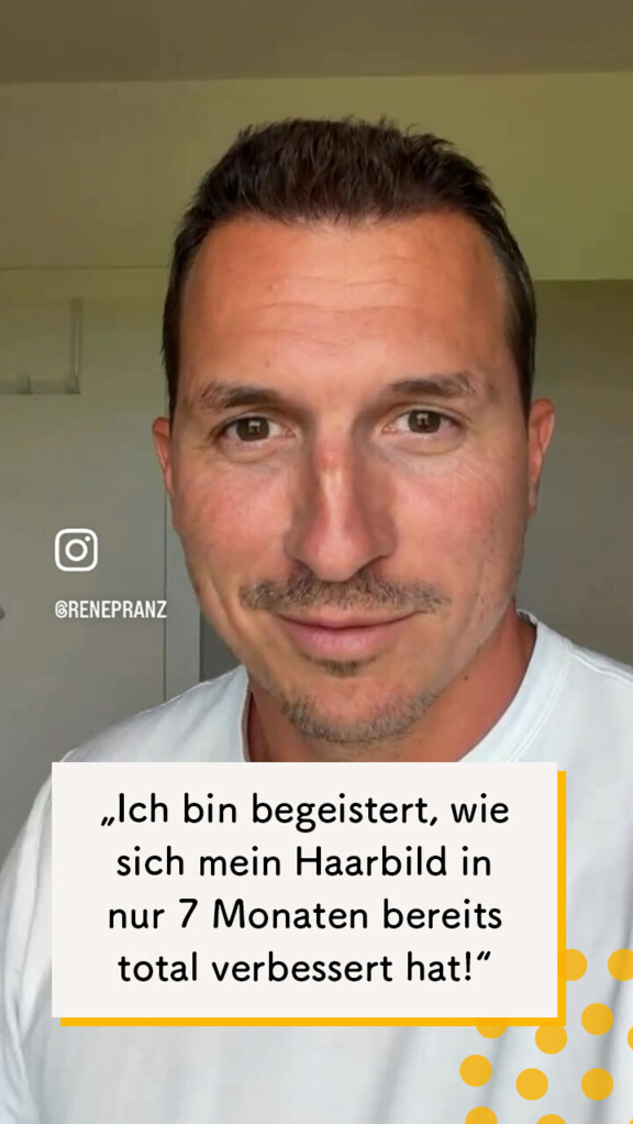 Nur ein halbes Jahr ist vergangen: "Meine Haarlinie ist einfach perfekt geworden!"