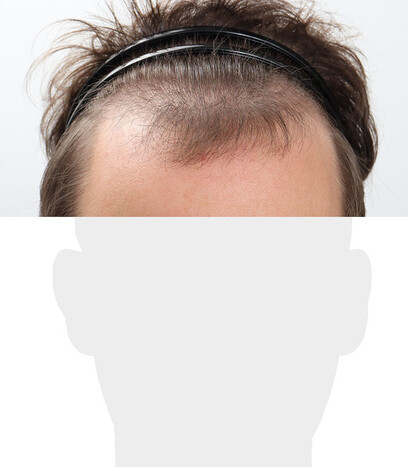 Herr Z. V. - Beispiel Stirnhaargrenze vor der Behandlung